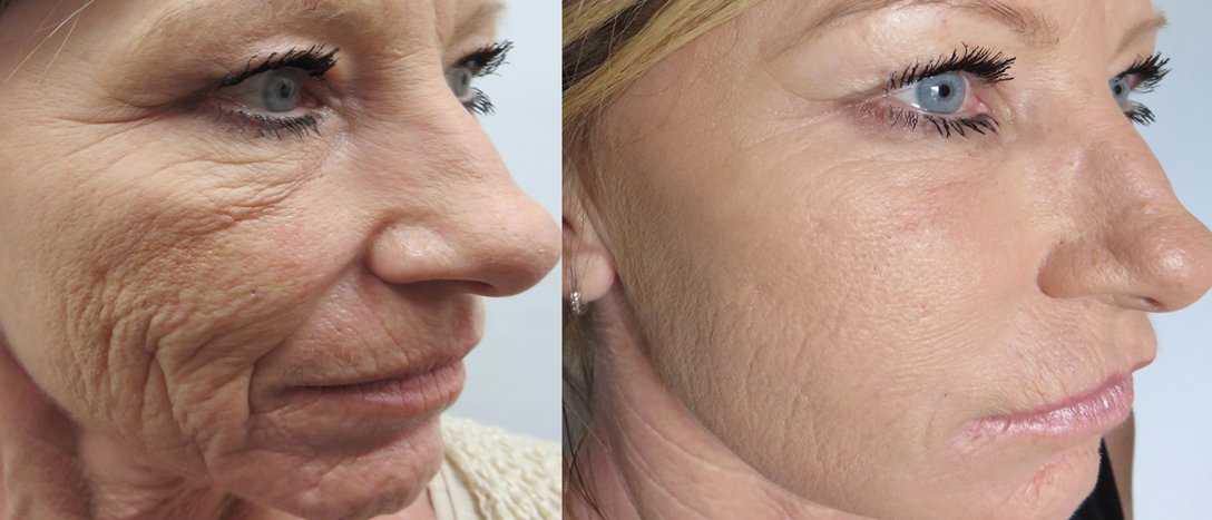 before-after before-after